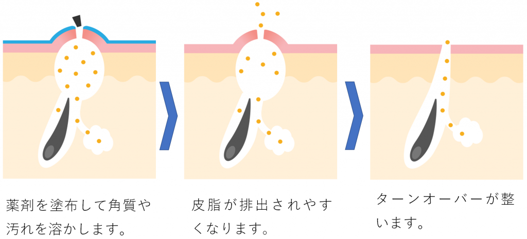 ピーリングの構図